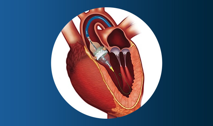 TAVI/TAVR Surgery in Navi Mumbai by Dr. Mahesh Ghogare